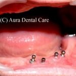 Lower Dental Implant Ball & Socket Denture
