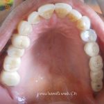 Dental Implant for Few Missing Teeth Vadodara