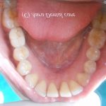 Single Dental Implants Baroda