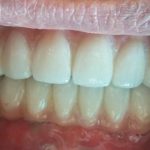 Upper and Lower Full Mouth Dental Implants in Baroda