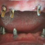 Upper and Lower Full Dental Implants