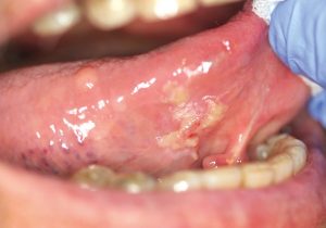 Denture sore spots due to postmenopausal atrophy