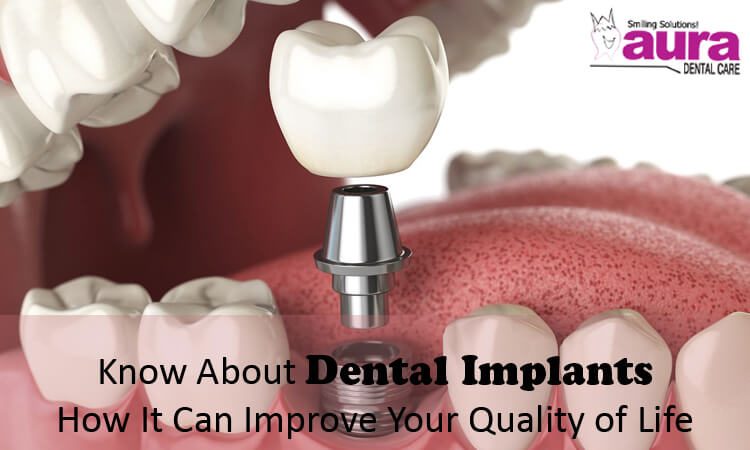 Know About Dental Implants How It Can Improve Your Quality of Life
